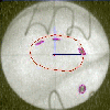 augentumortherapie  - enlarged view