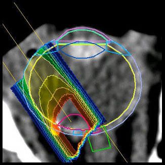 Display of the proton dose distribution - enlarged view