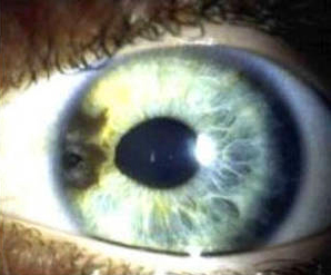 iris melanoma - enlarged view