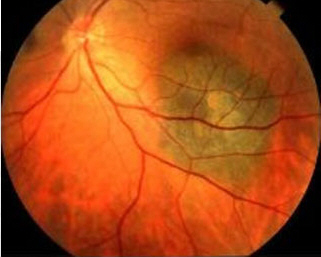photography of eyeground - enlarged view