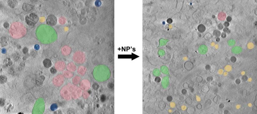 Die Aufnahmen zeigen: Nach Aufnahme von Nanopartikeln (rechtes Bild) gibt es in der Zelle weniger Lipidtr&ouml;pfchen (blau) und multivesikul&auml;re K&ouml;rperchen (rosa) und daf&uuml;r mehr Mitochondrien (gr&uuml;n) und Endosomen (gelb).</p> <p></p> <p>
