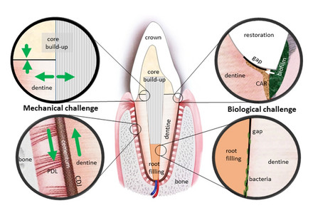 Artificial and natural interzones on a tooth restored with non-degradable biomaterials are exposed to mechanical (left: stresses acting in compression, tension and shear) and biological challenges (right: bacterial attachment, penetration, and other interactions with biological media).