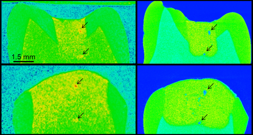 Die Neutronentomographie-Aufnahmen (linke Spalte) zeigen, wie sich Fl&uuml;ssigkeit in dieser Zahnf&uuml;llung verteilt, w&auml;hrend die R&ouml;ntgen-CT-Aufnahmen (rechte Spalte) Mikrostruktur und Poren der gleichen Probe abbilden. Der Vergleich erlaubt zu sehen, welche Poren mit Fl&uuml;ssigkeit gef&uuml;llt sind. <span></span>